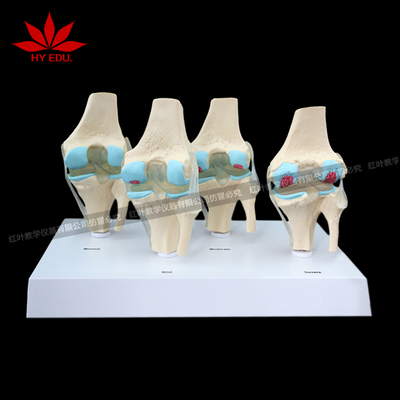 4阶段病变膝关节医用模型