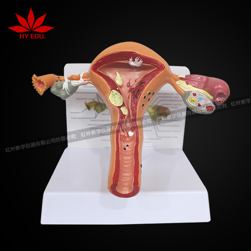 病理子宫模型