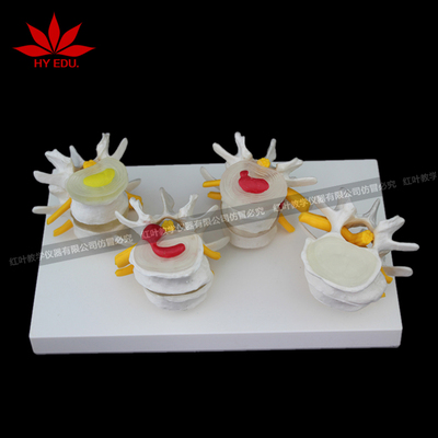 4阶段病变腰椎医用模型