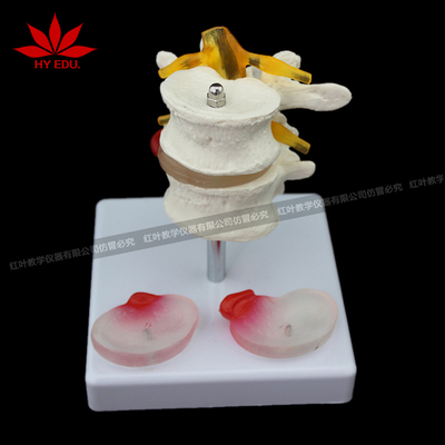 2节腰椎病变医用模型